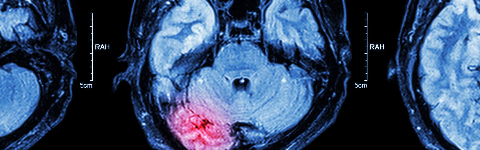 image of a brain injury